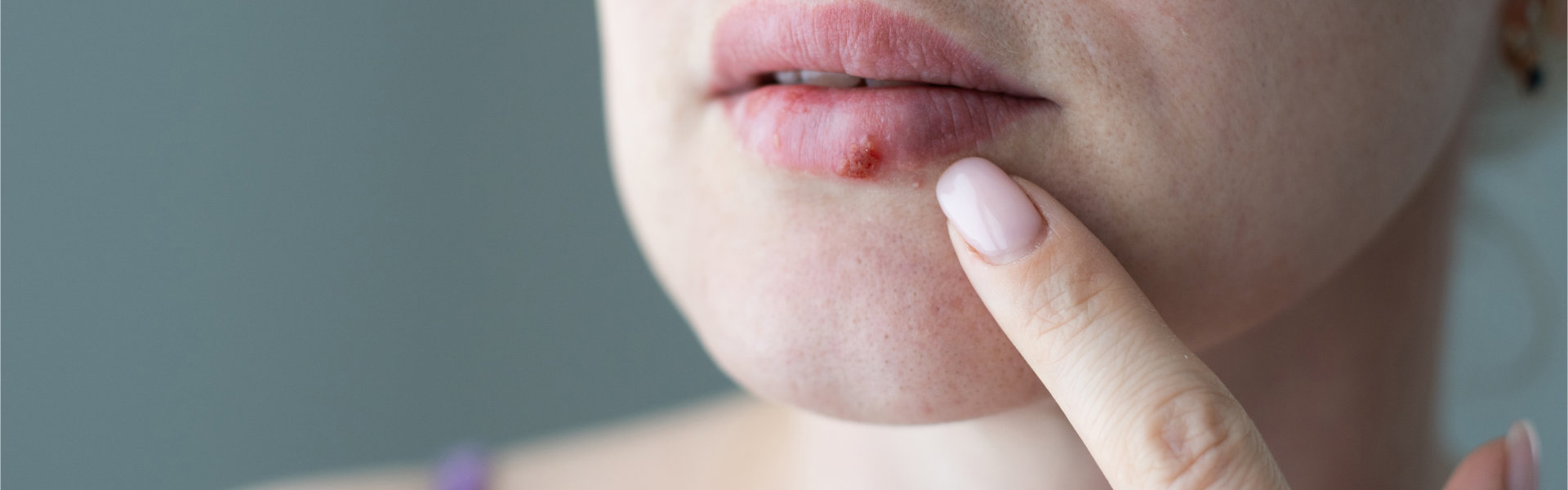 a woman touching her acne