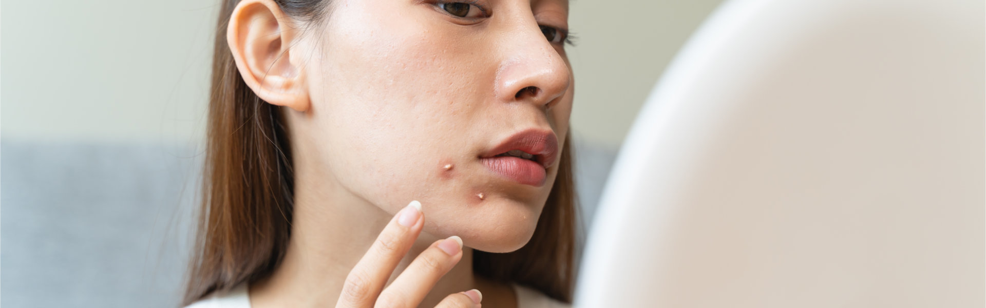 a woman with acne on her face